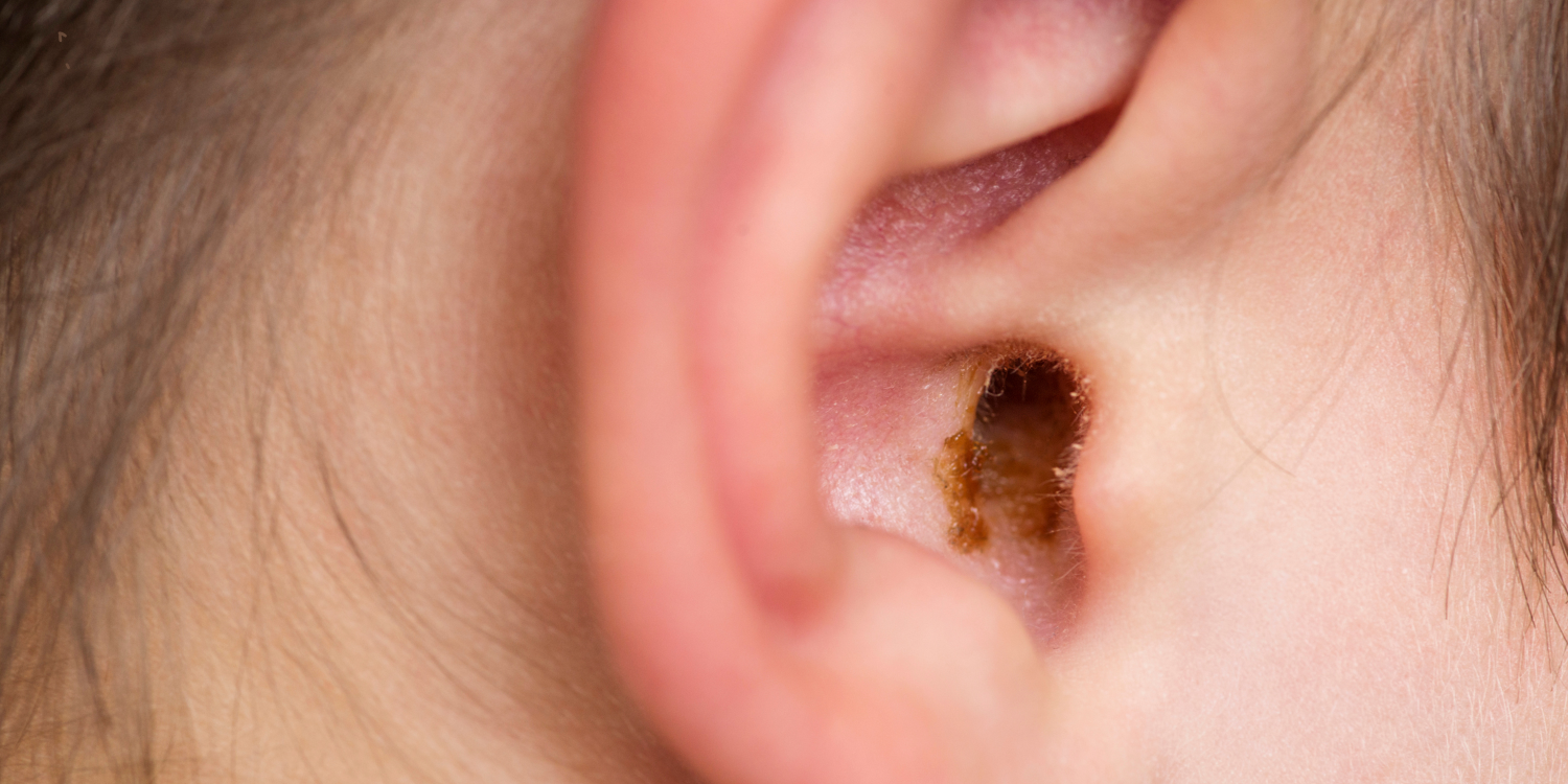 Ear Wax Removal in Nuneaton – What to Expect at Crowhill Pharmacy