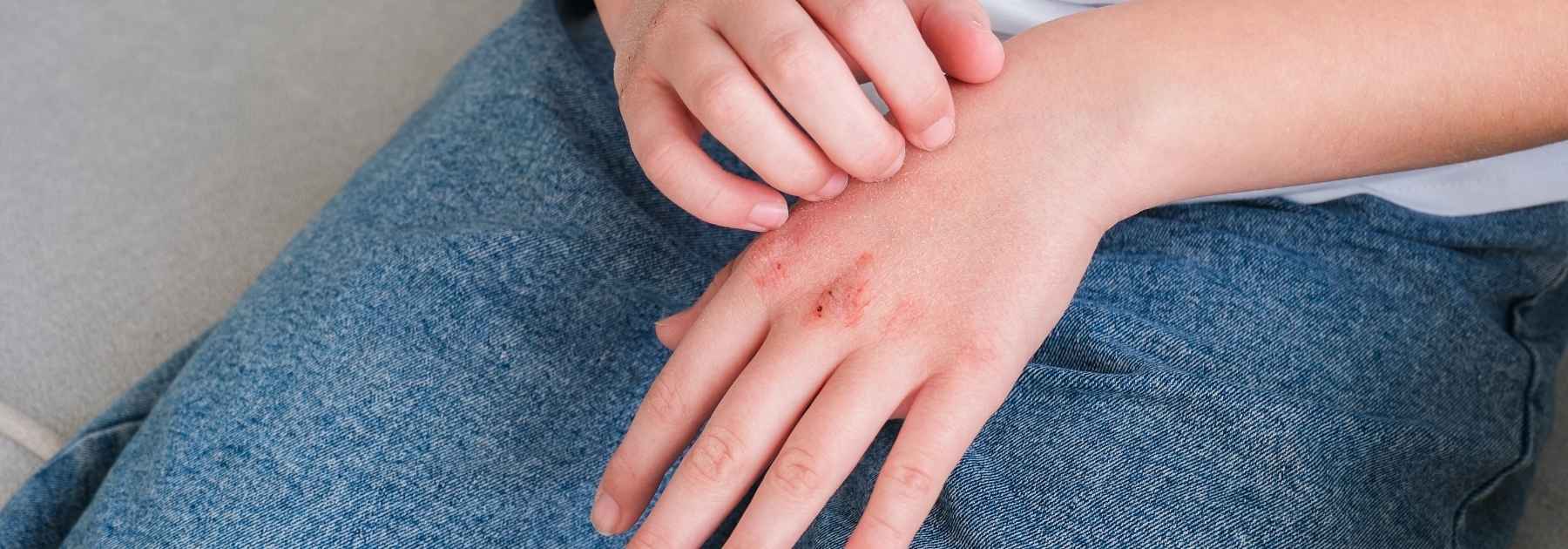 Impetigo treatment in Nuneaton