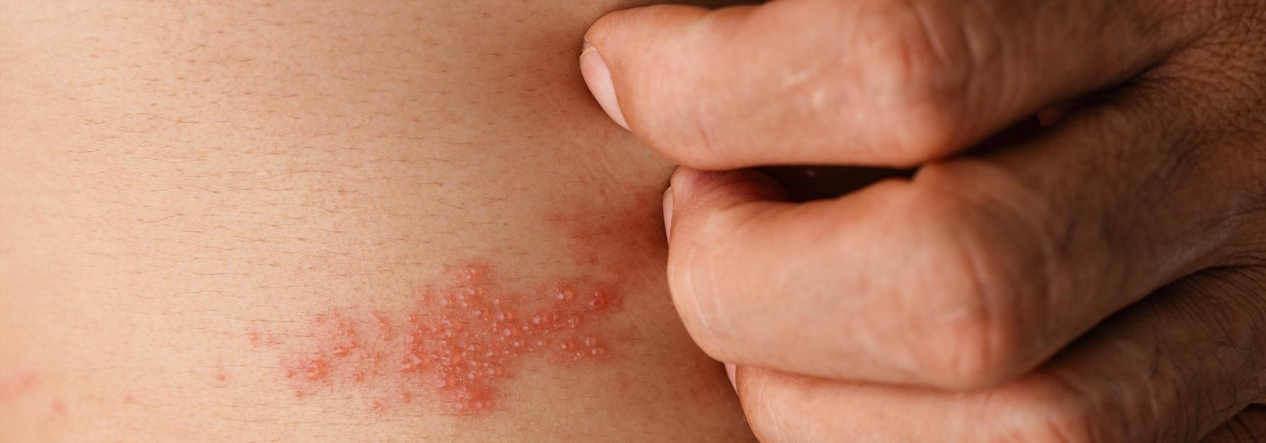 Shingles treatment in Nuneaton