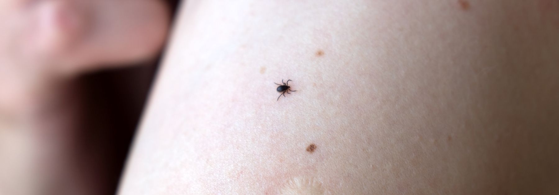 Tick on Arm