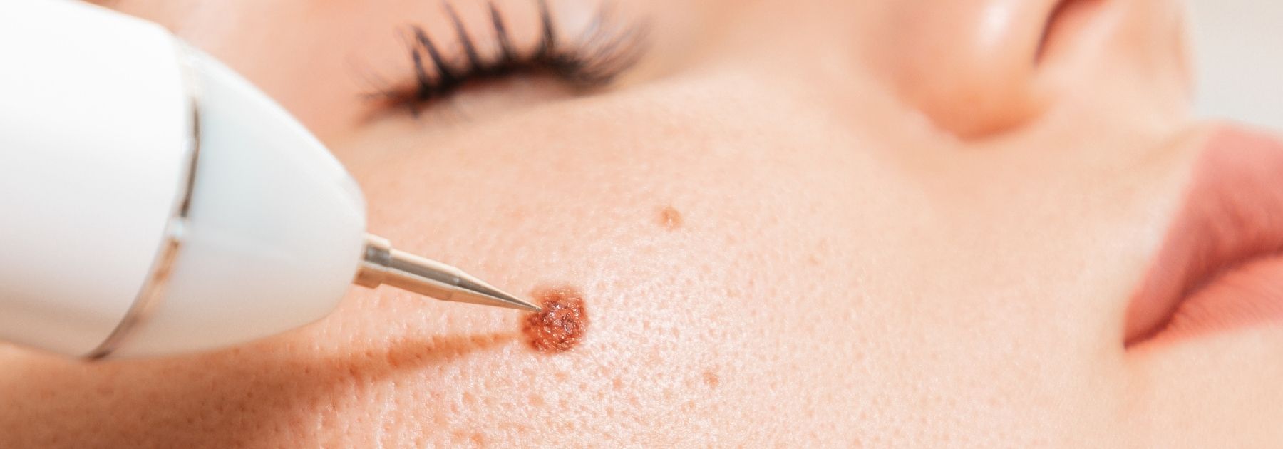 Wart Removal Nuneaton