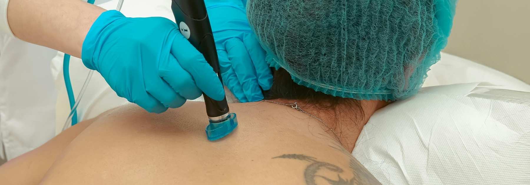 Skin Tag Removal Nuneaton